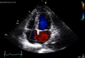 echocardiogram