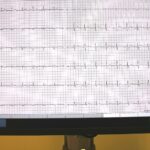 Elektrokardiografija (EKG) Elektrokardiografija (EKG)